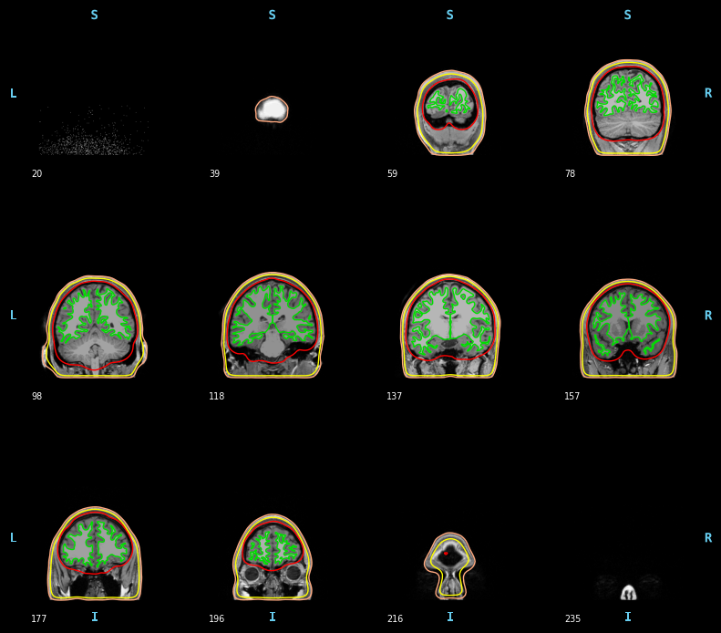../../../_images/6-meg-pipeline-gallery_notebooks_mne_mne_kit_computing_bem_model_16_3.png